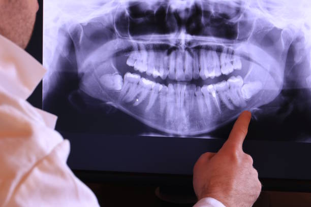 Best Emergency Dental Extractions in Mill Valley, CA